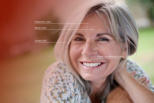 Botox Cosmetic treatment areas